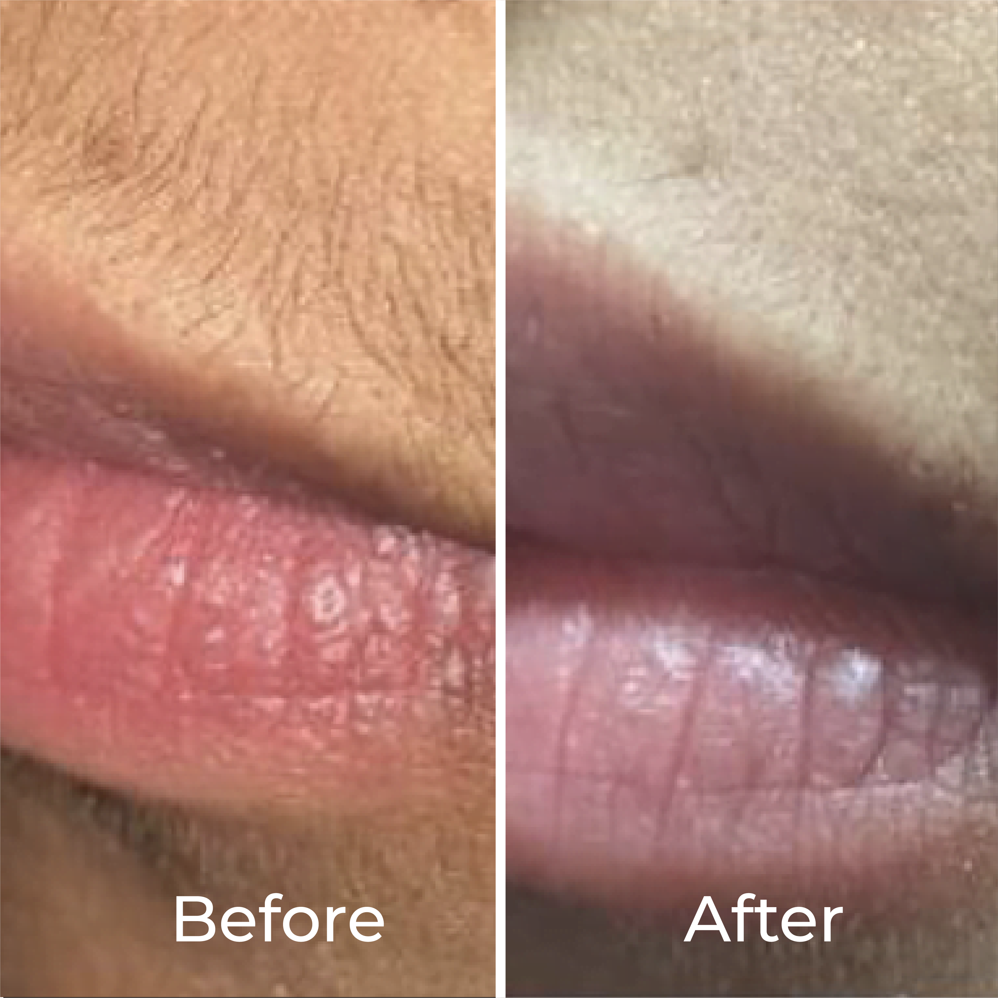 Permanent Facial Hair Removal Pack