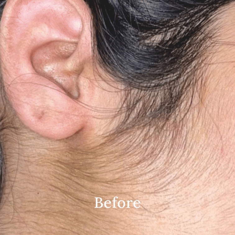 Permanent Facial Hair Removal Pack