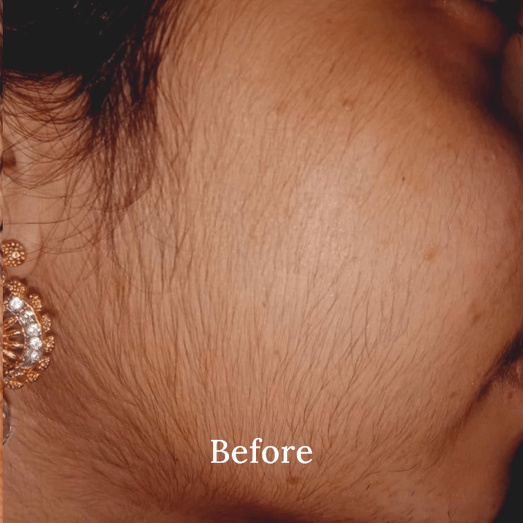 Permanent Facial Hair Removal Pack