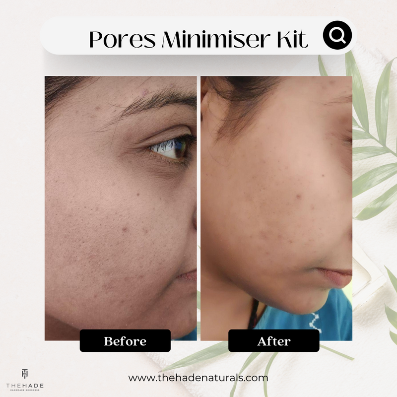 Pores Minimiser Kit